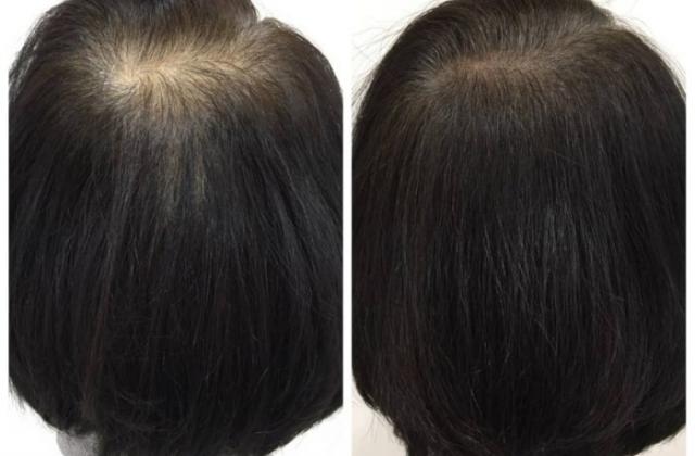 还在为脱发而苦恼吗？韩国娜瑞斯特“头皮色素疗法SMP”课程助你一臂之力